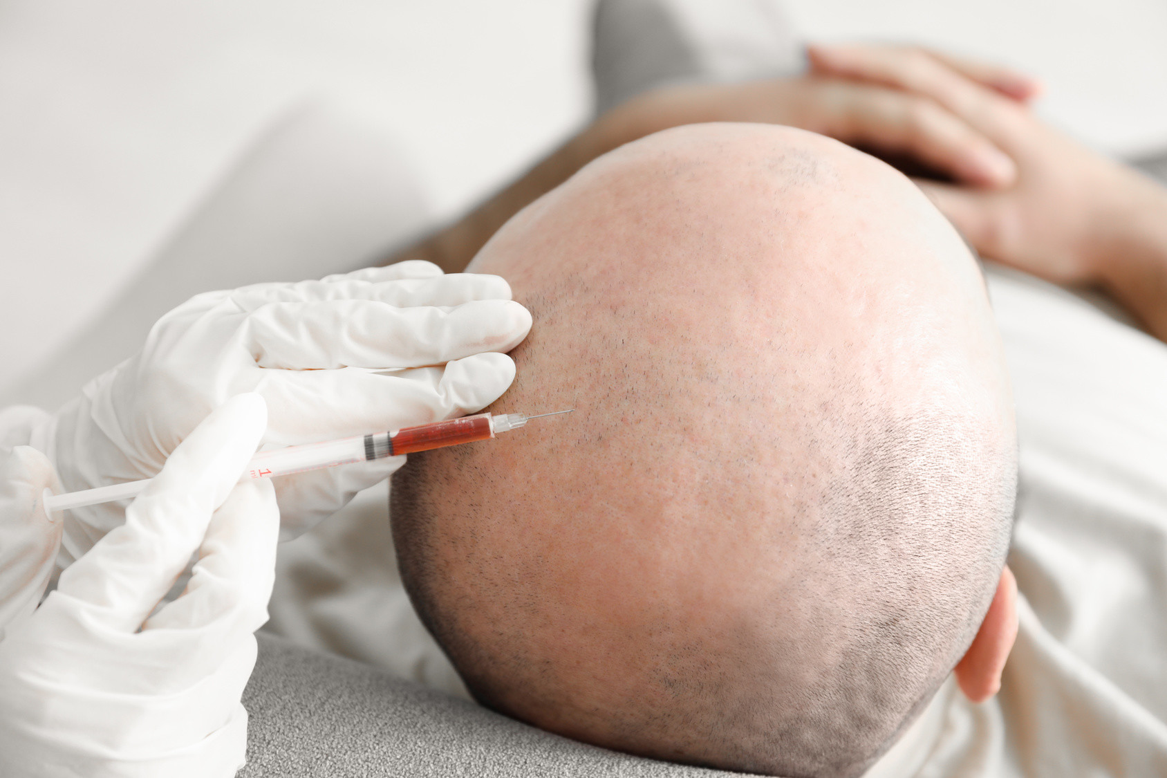 PRP Therapie