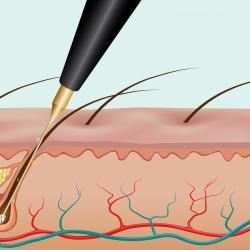 Haartransplantation Methoden Haartransplantation Methoden