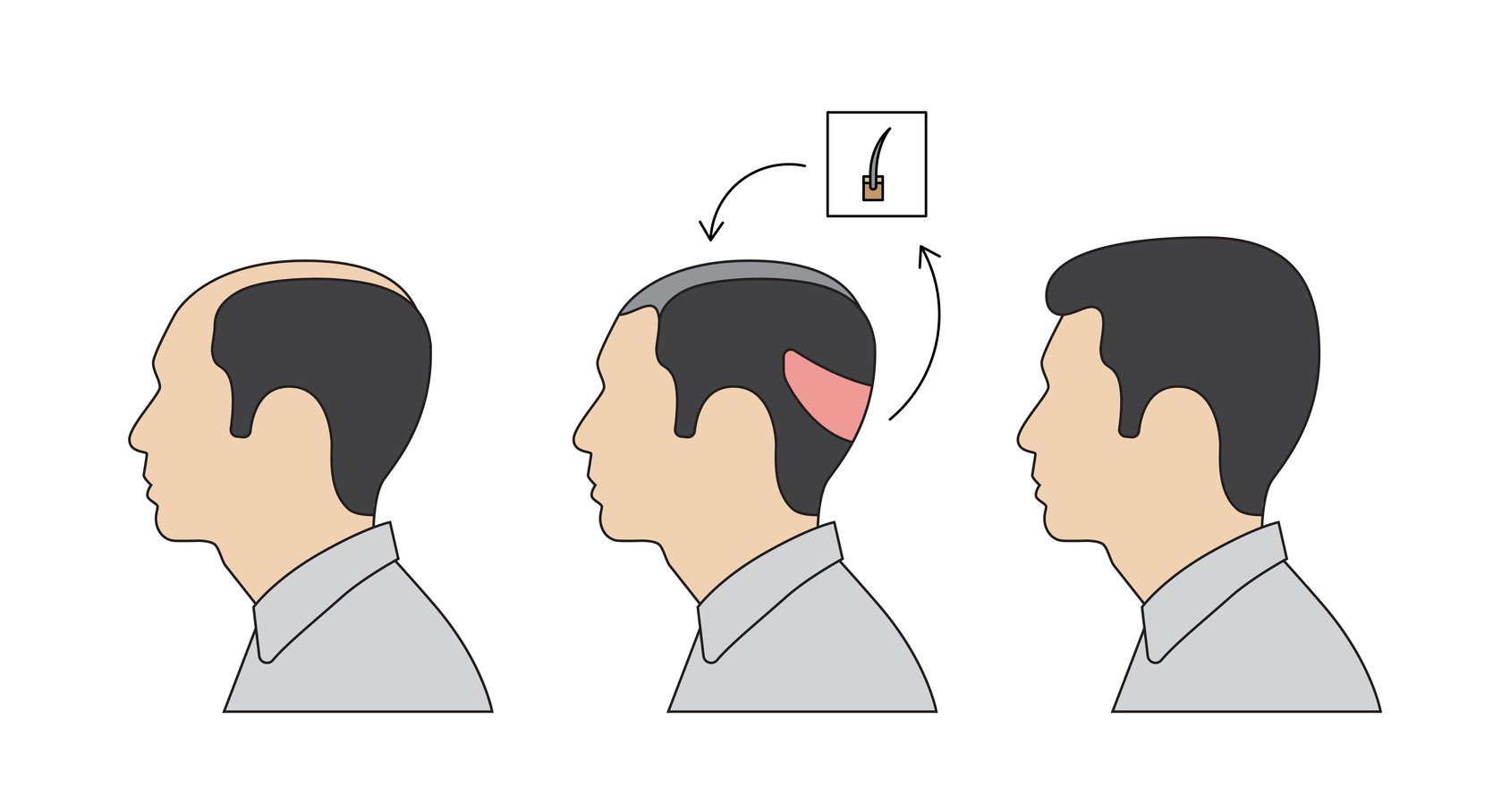 Spenderbereich nach der Haartransplantation