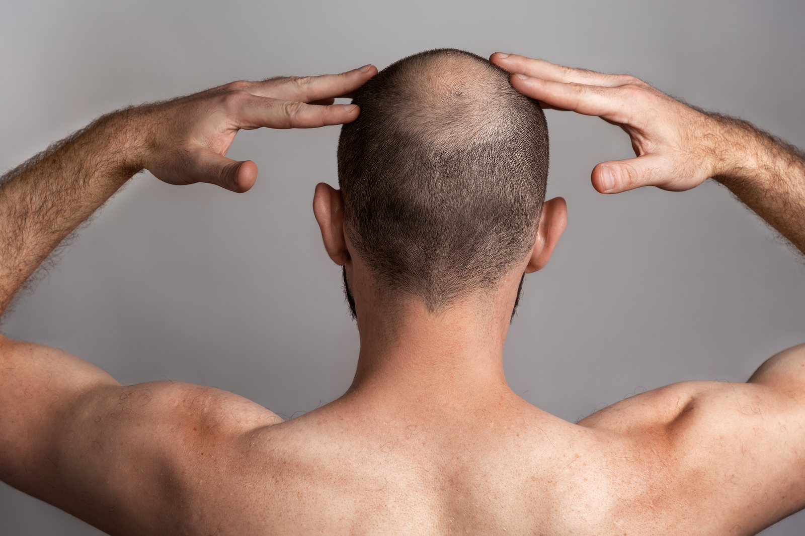 Diffuser Haarausfall