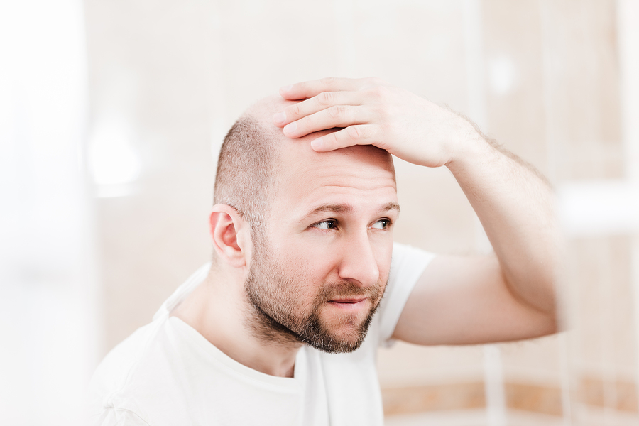 Erblich bedingter Haarausfall