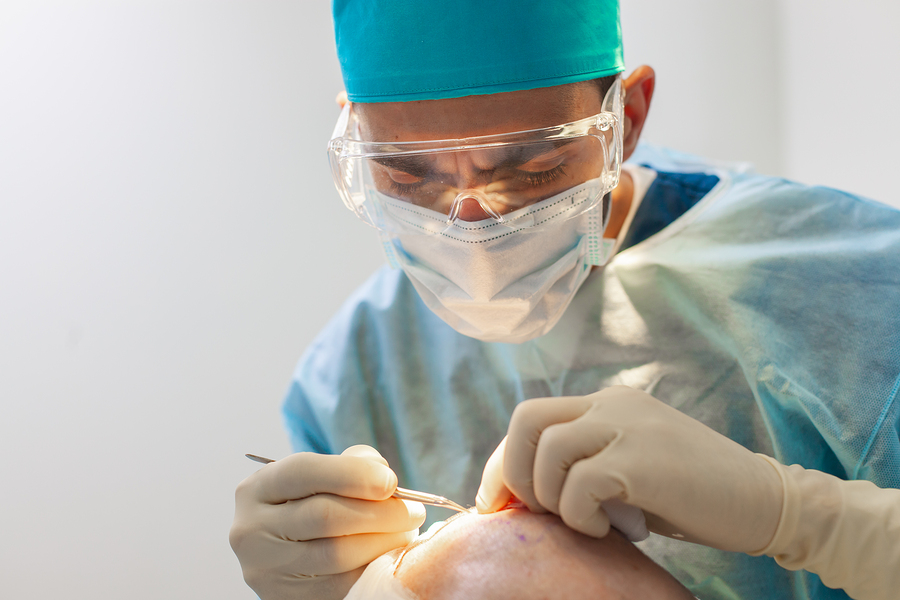 Haartransplantation mittels Crosspunch-Methode
