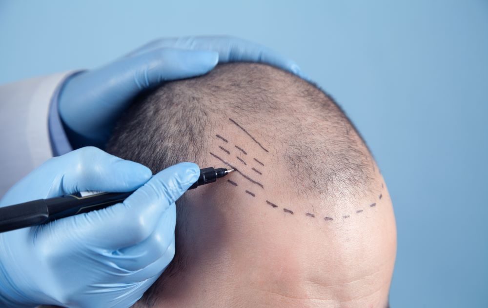 Haartransplantation Methode