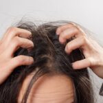 Haarausfall durch trockene Kopfhaut